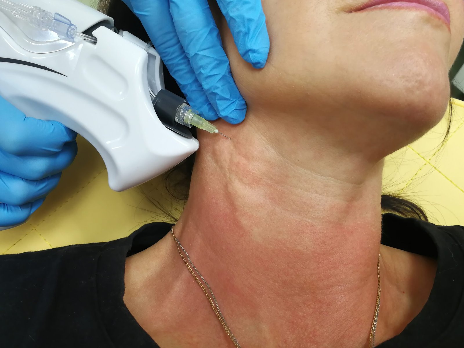 Neck rejuvenation treatment in progress at Couture Dermatology and Laser Beverly Hills Beverly Hills