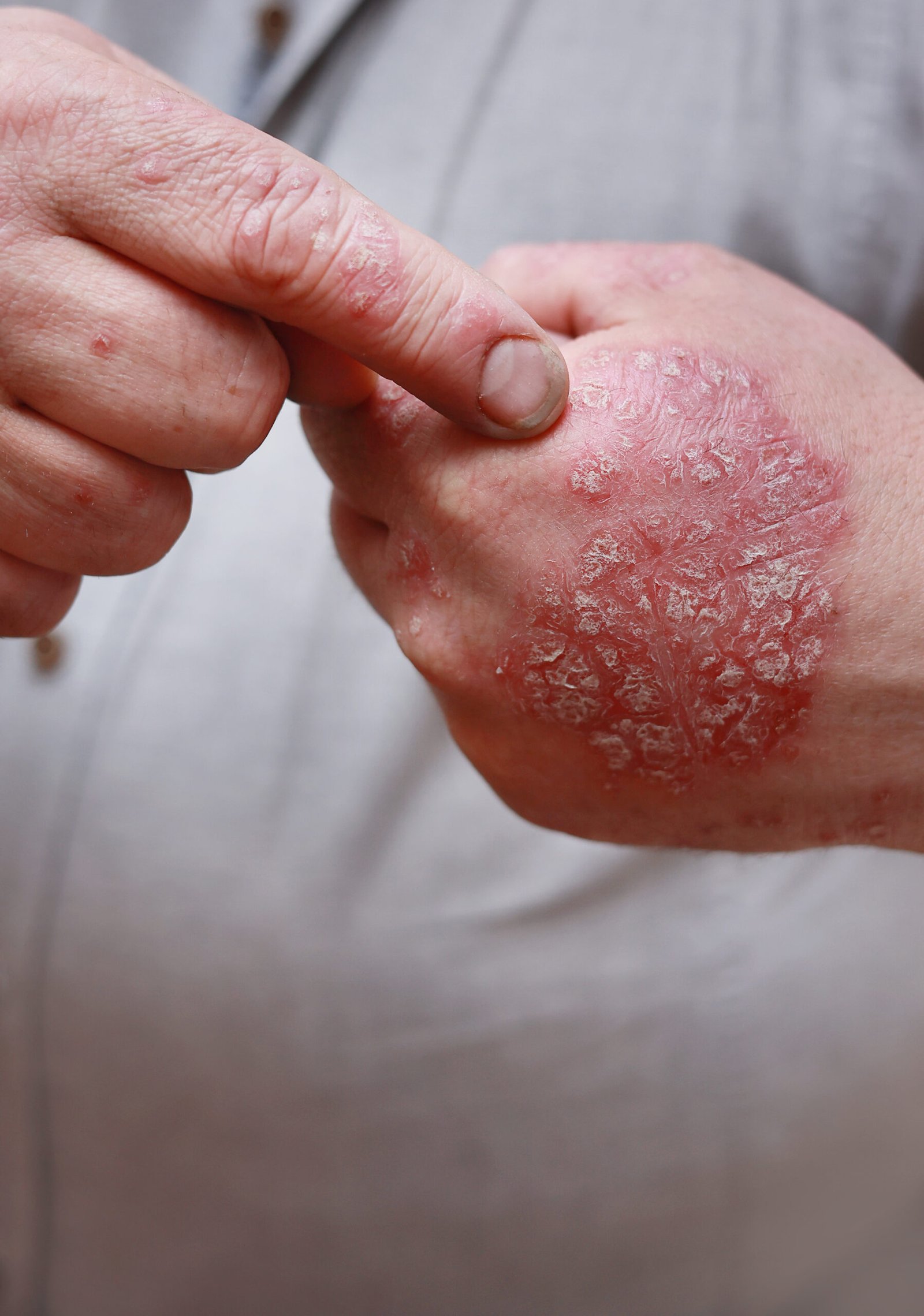 Close-up of hands with psoriasis plaques at Couture Dermatology and Laser