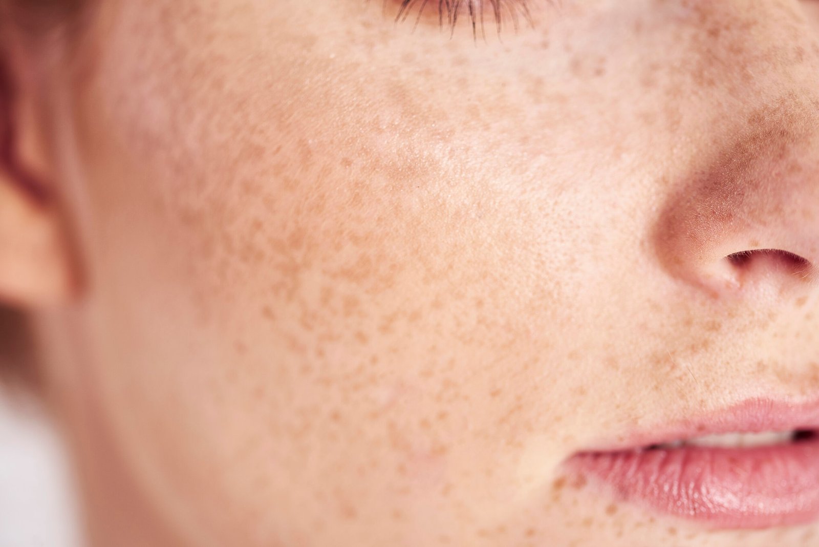 Close-up of woman's face with skin pigmentation at Couture Dermatology and Laser