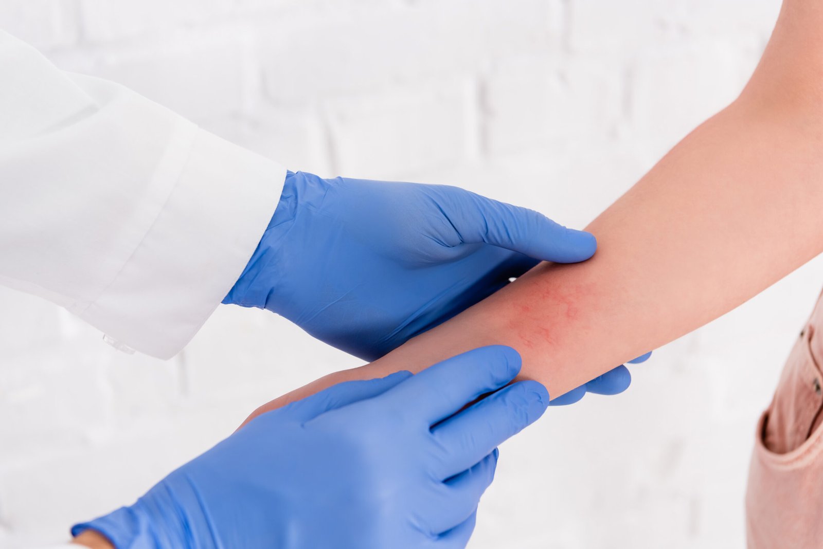 Dermatologist examining eczema at Couture Dermatology and Laser Beverly Hills