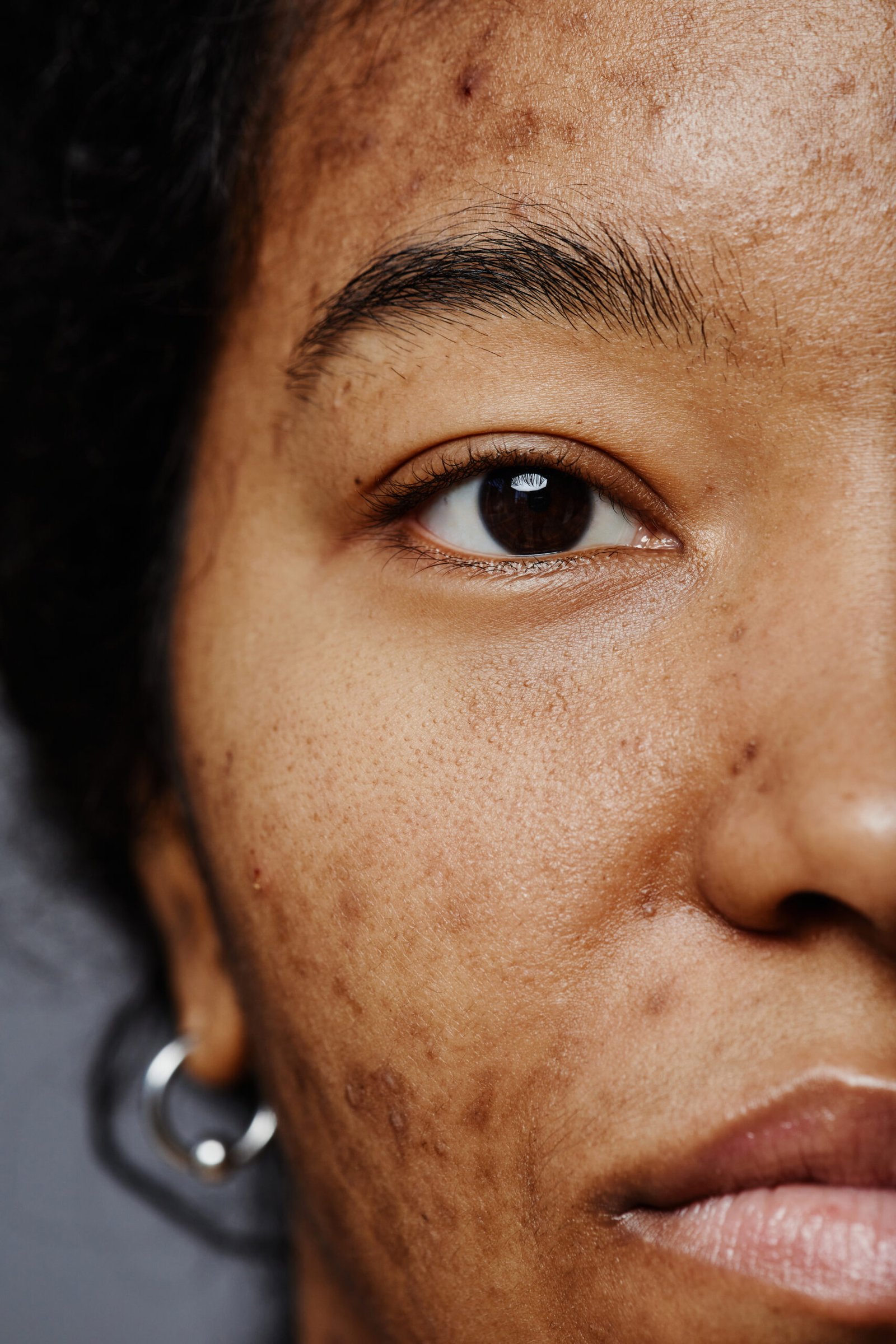 Dermatologist performing hyperpigmentation treatment at Couture Dermatology and Laser