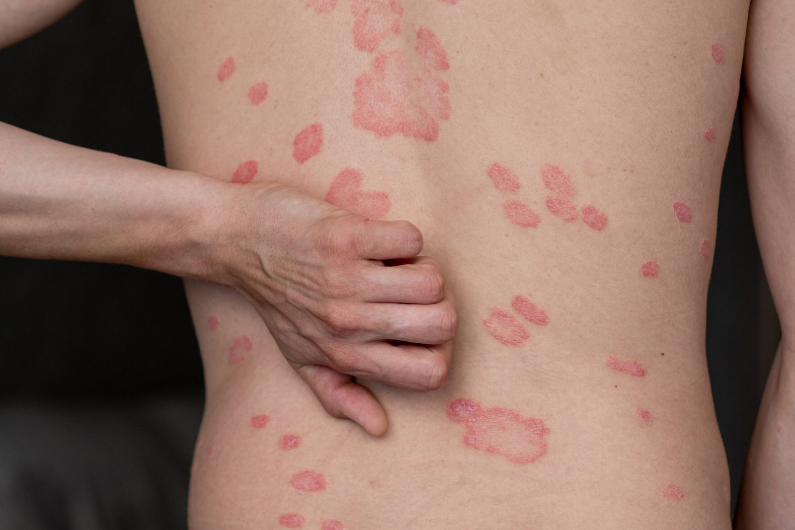 Close-up of inflamed skin rash showing red patches at Couture Dermatology and Laser Beverly Hills Beverly Hills