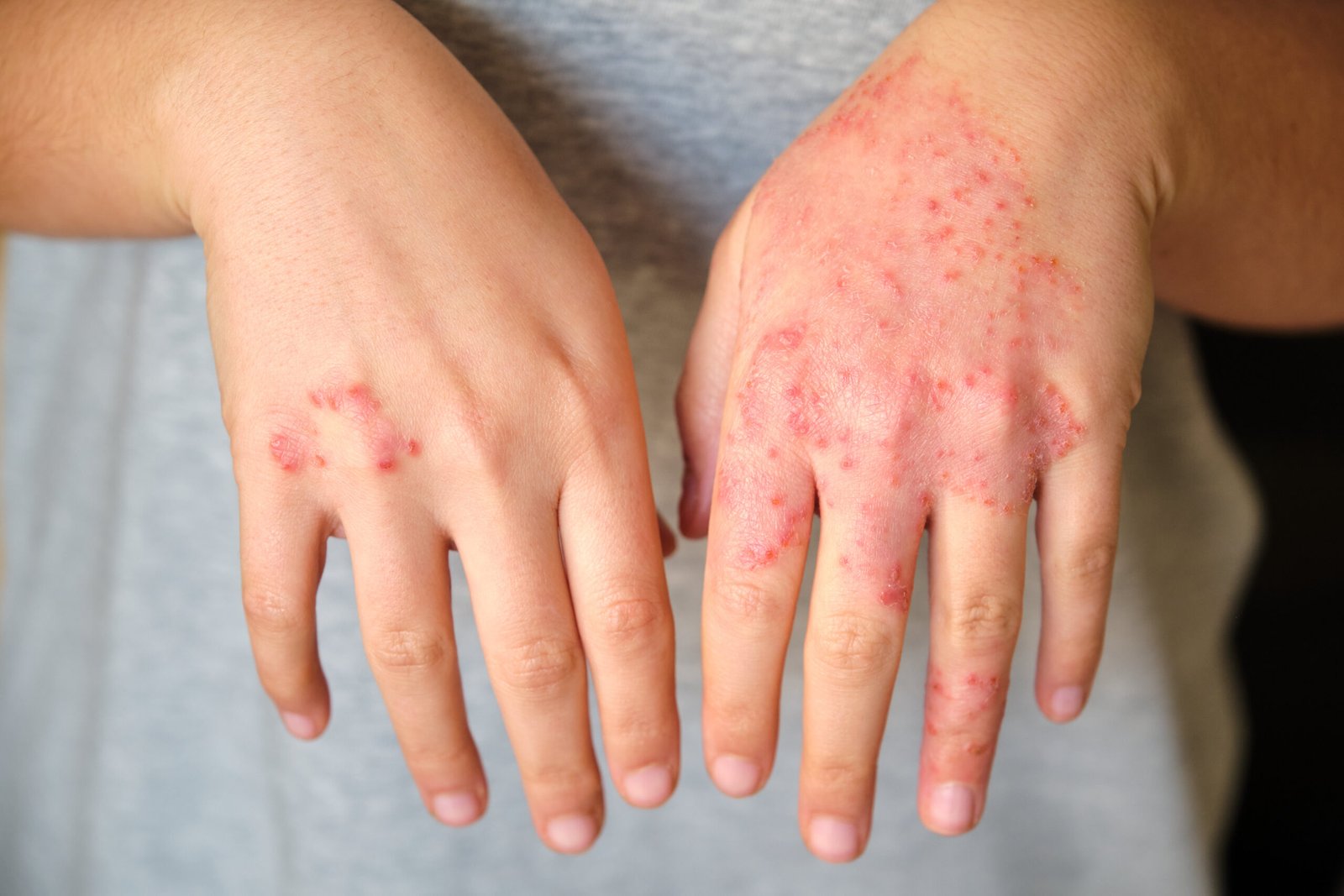 Close-up of eczema and contact dermatitis on hands at Couture Dermatology and Laser Beverly Hills
