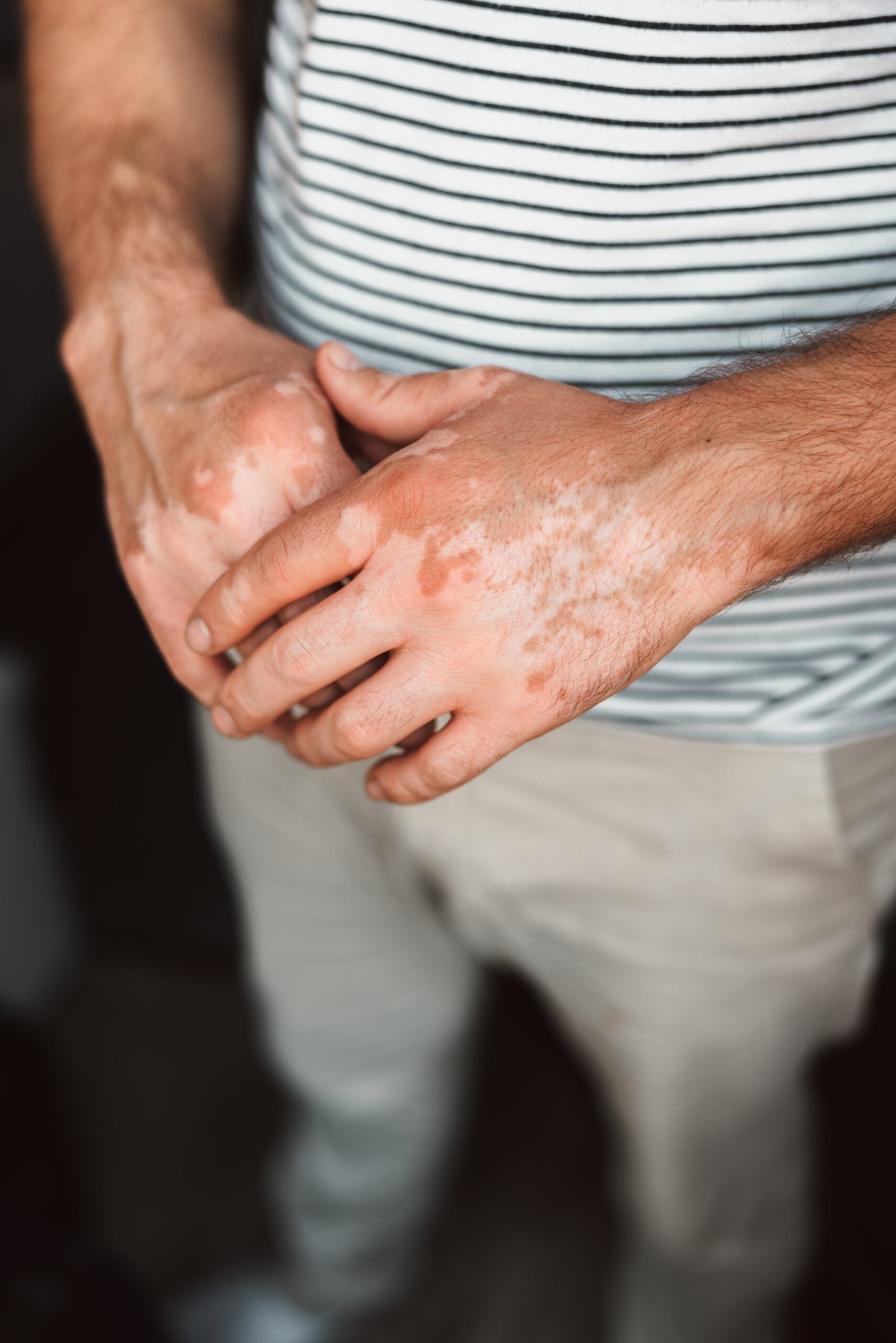 Close-up of skin condition illustrating immune-mediated disease at Couture Dermatology and Laser