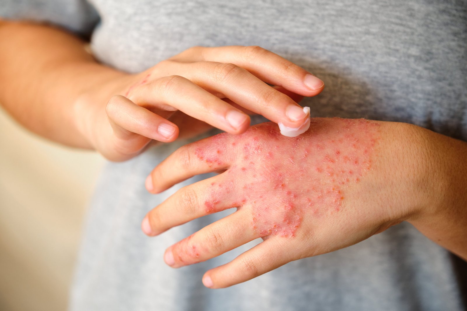 Woman applying moisturising cream for eczema management at Couture Dermatology and Laser