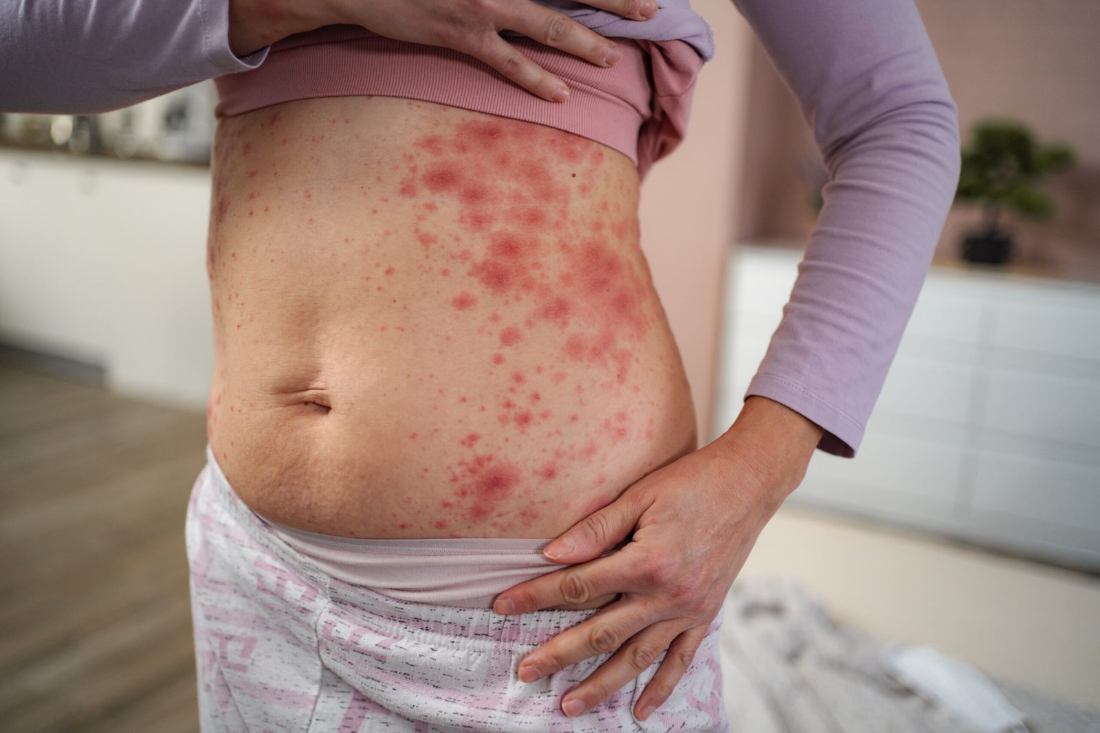Woman showing red skin rash from allergy at Couture Dermatology and Laser Beverly Hills Beverly Hills