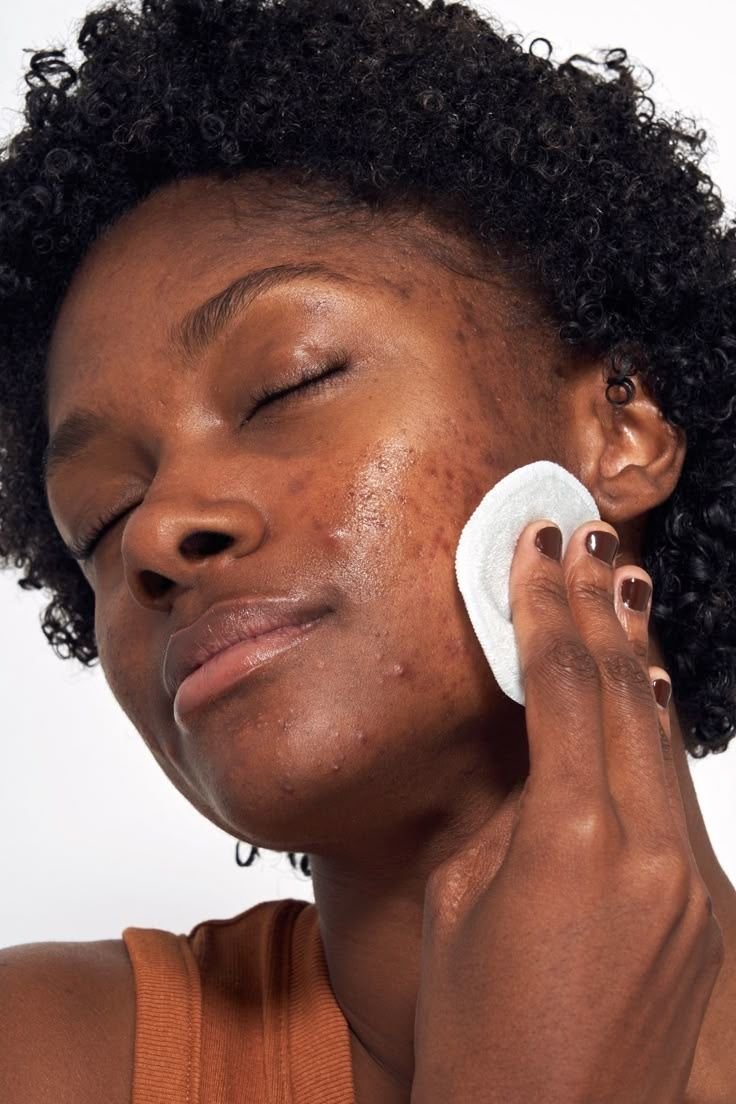 Woman with clear, calm skin after rosacea treatment at Couture Dermatology and Laser Beverly Hills